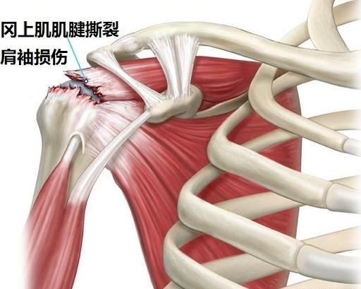 练瑜伽时肩膀容易受伤怎么办 如何预防和缓解