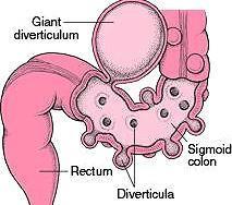 左下腹疼 有哪些常见的病因 该咋办 医生给您讲清楚