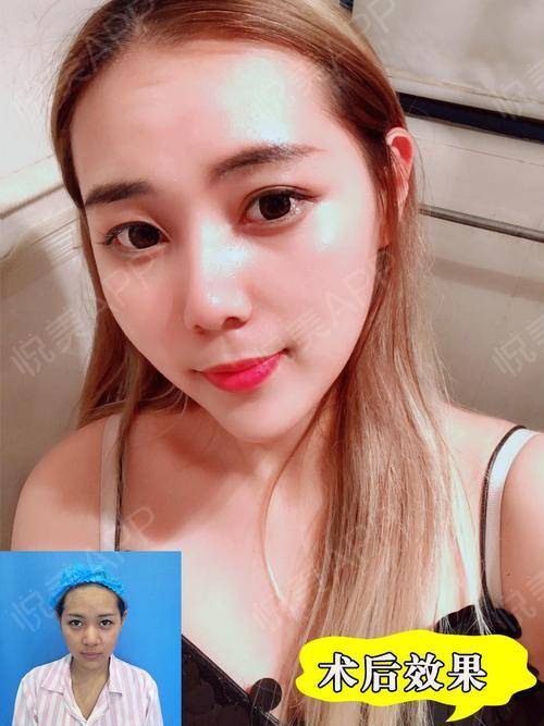 鼻子经常长痘可以做隆鼻手术吗 会不会有什么副作用